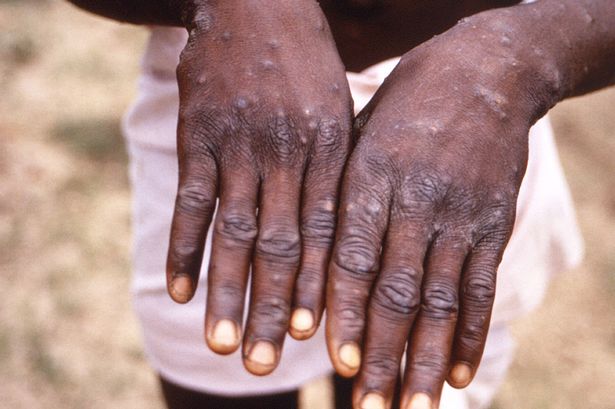 Ghana records MPox case in Western North Region